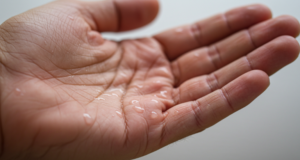 Man holding sweat suffering with hyperhidrosis