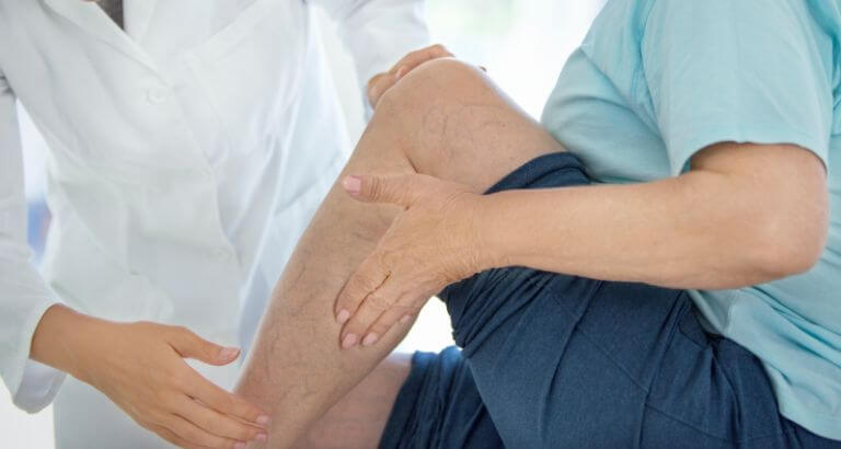 Womans leg with thread veins on them